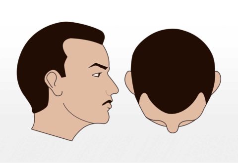1500-2000 Grafts