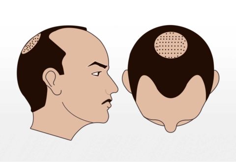 2500-3000 Grafts