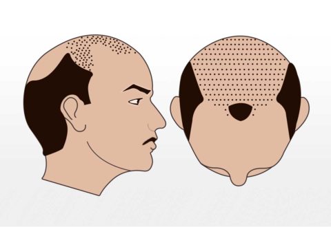 3000-3500 Grafts