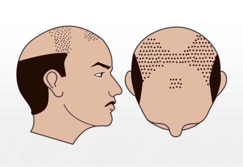 4000-7000 Grafts