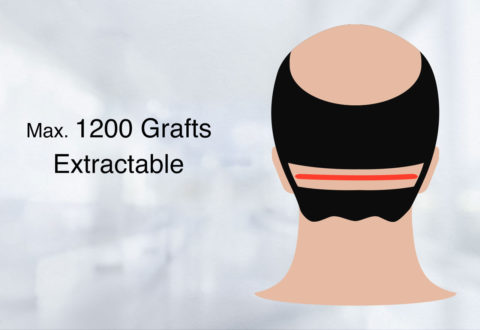 Hair Transplant Fut Technique