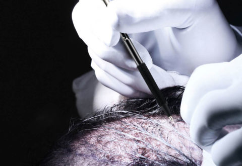 Hair Transplant Perkutan FUE Technique