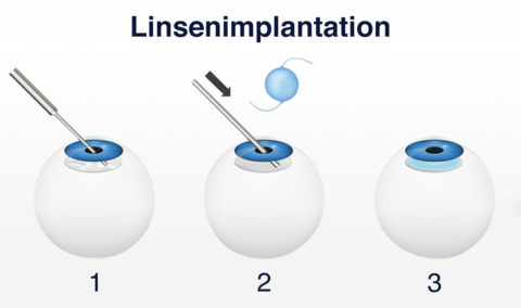 Lens implantation istanbul